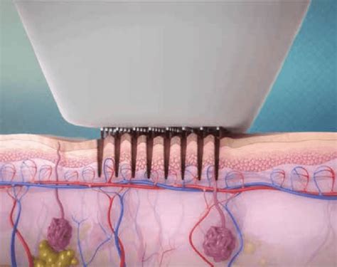 venus viva singapore|Venus Viva Neck Lines Reduction .